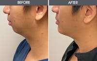 Chin Implants Before & After Gallery - Patient 123718814 - Image 1