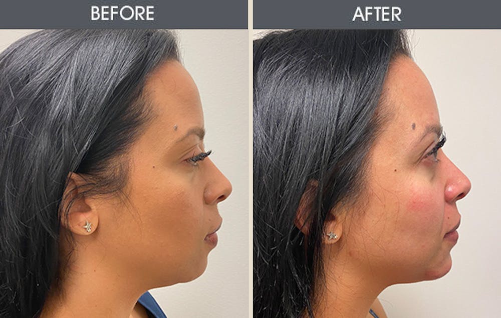 Dermal Fillers Gallery Before & After Gallery - Patient 123718815 - Image 1