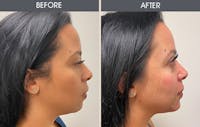 Dermal Fillers Before & After Gallery - Patient 123718815 - Image 1