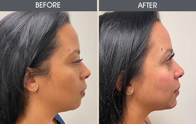 Fillers Before & After Gallery - Patient 123718815 - Image 1