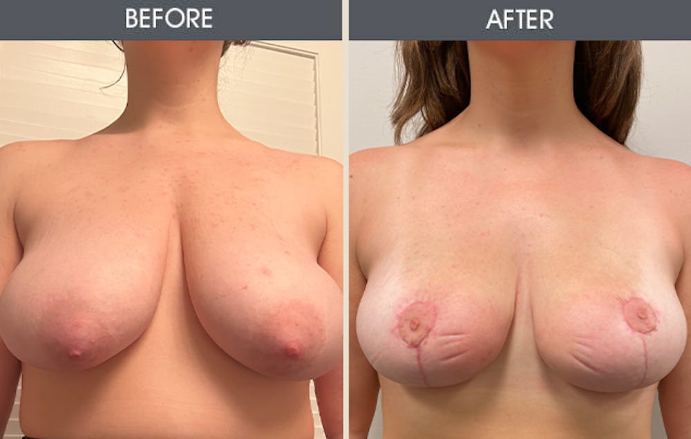 Breast Reduction Before & After Gallery - Patient 141185776 - Image 1