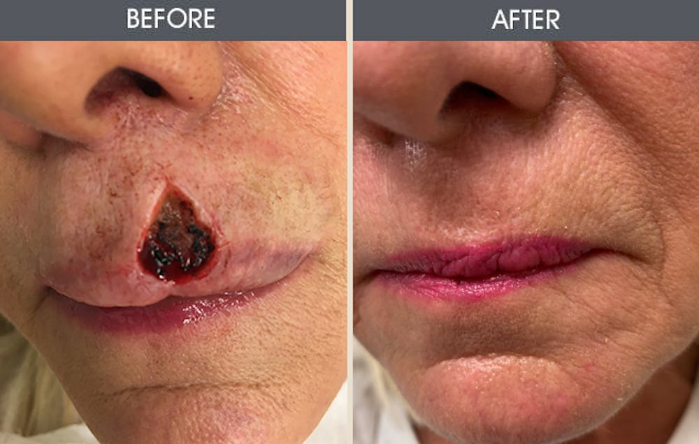 Skin Cancer Reconstruction Before & After Gallery - Patient 141185789 - Image 1