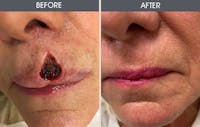Skin Cancer Reconstruction Before & After Gallery - Patient 141185789 - Image 1