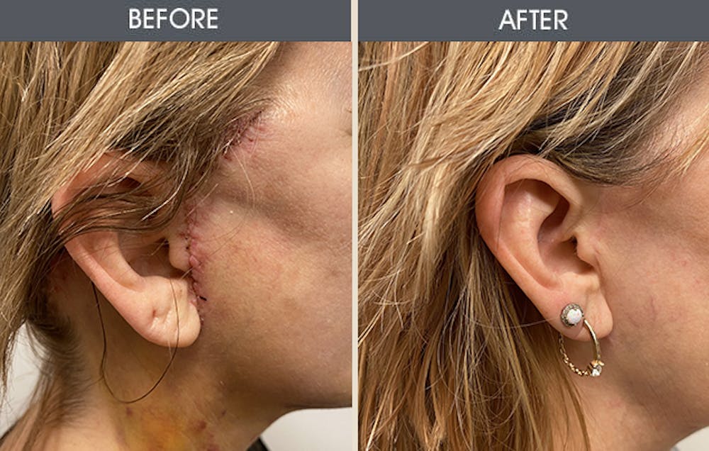 Scar Revision Gallery Before & After Gallery - Patient 141185813 - Image 1