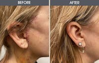 Scar Revision Gallery Before & After Gallery - Patient 141185813 - Image 1