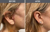 Scar Revision Before & After Gallery - Patient 141185813 - Image 1