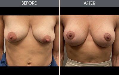 Breast Augmentation Before & After Gallery - Patient 146209693 - Image 1
