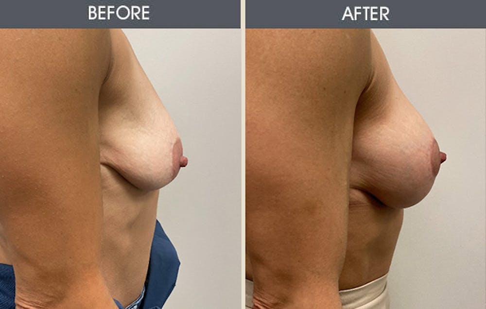Breast Augmentation Before & After Gallery - Patient 146209693 - Image 2