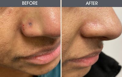 Scar Revision Before & After Gallery - Patient 147416111 - Image 1