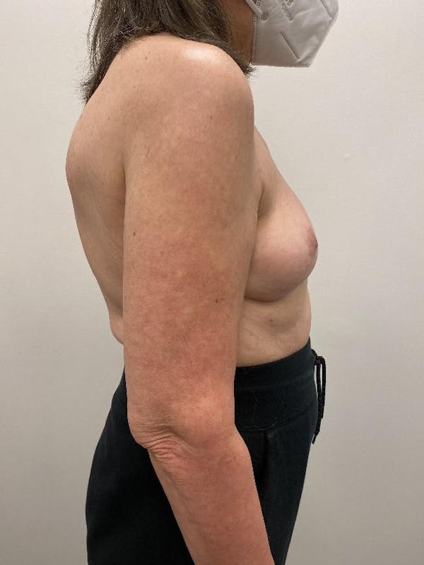 Breast Implant Removal Before & After Gallery - Patient 148128632 - Image 2