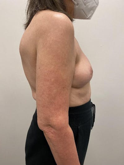 Breast Implant Removal Before & After Gallery - Patient 148128632 - Image 2