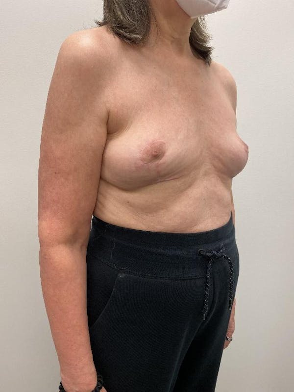Breast Implant Removal Before & After Gallery - Patient 148128632 - Image 4