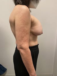 Breast Implant Removal Before & After Gallery - Patient 148128632 - Image 1