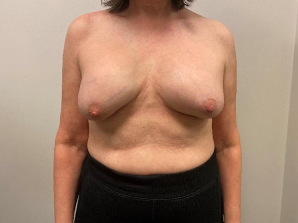 Breast Implant Removal Before & After Gallery - Patient 148128632 - Image 5