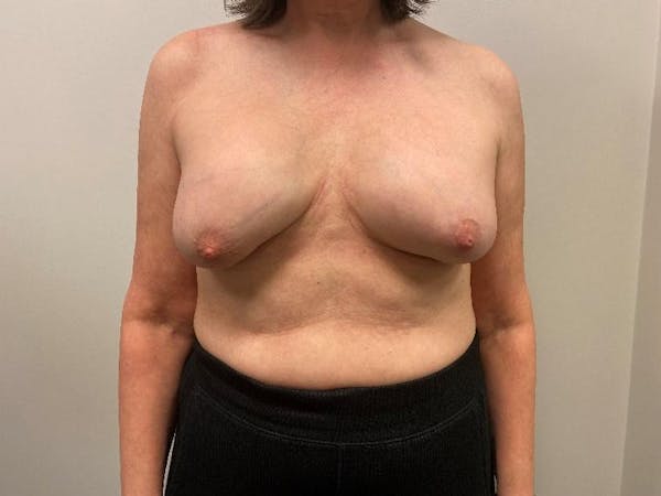Breast Implant Removal Gallery Before & After Gallery - Patient 148128632 - Image 5