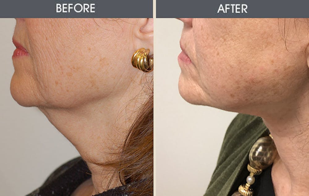 Neck Lift Gallery Before & After Gallery - Patient 148410945 - Image 1