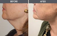 Neck Lift Before & After Gallery - Patient 148410945 - Image 1
