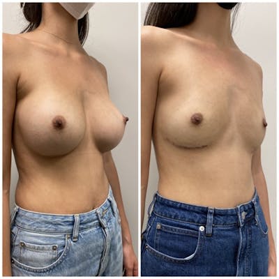 Breast Implant Removal Before & After Gallery - Patient 148410954 - Image 1