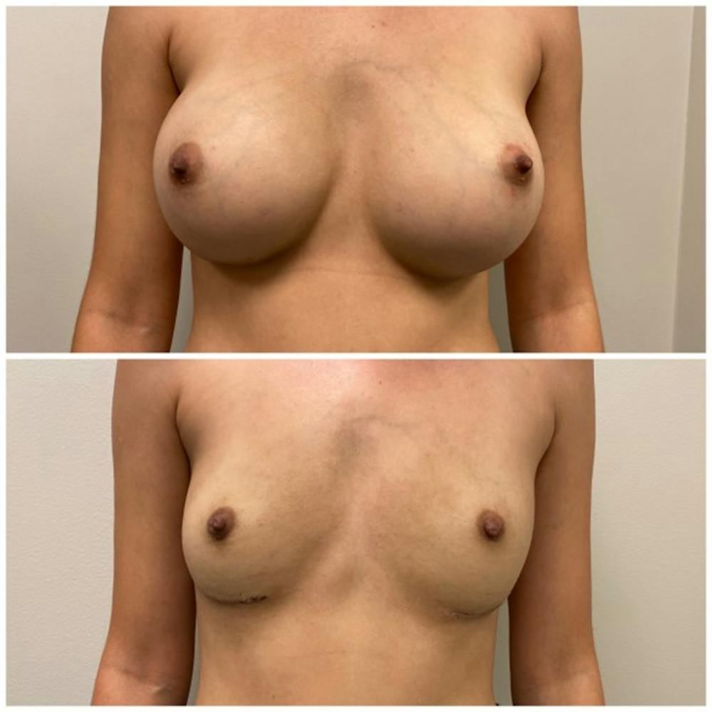 Breast Implant Removal Before & After Gallery - Patient 148410954 - Image 2