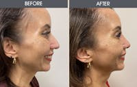 Rhinoplasty Gallery Before & After Gallery - Patient 148410959 - Image 1