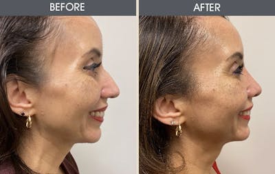 Rhinoplasty Before & After Gallery - Patient 148410959 - Image 1