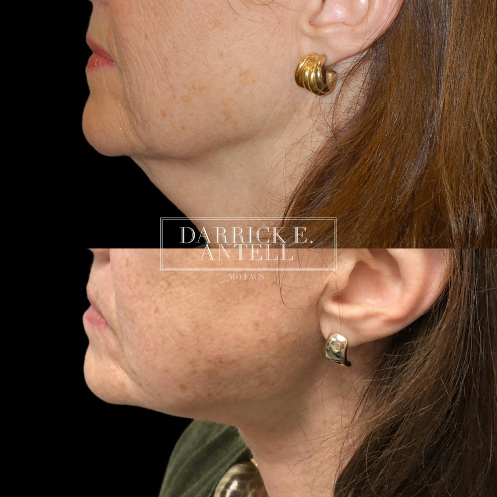 Neck Lift Before & After Gallery - Patient 148466864 - Image 1