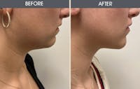 Submental Liposuction Before & After Gallery - Patient 148520343 - Image 1