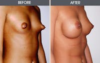 Tuberous Breast Correction Gallery Before & After Gallery - Patient 149192921 - Image 1