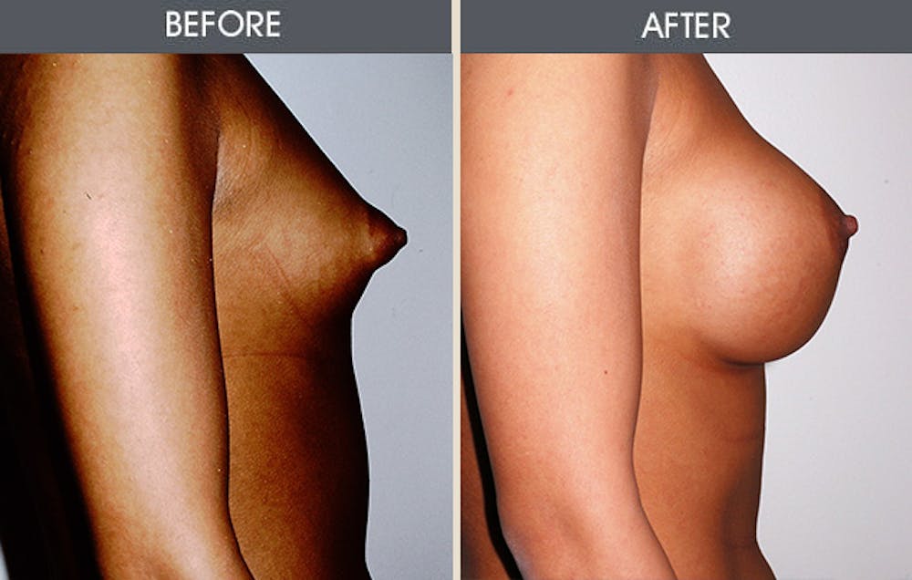 Tuberous Breast Correction Gallery Before & After Gallery - Patient 149192921 - Image 2