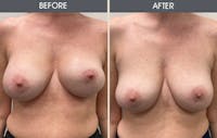 Breast Revision Gallery Before & After Gallery - Patient 149430786 - Image 1