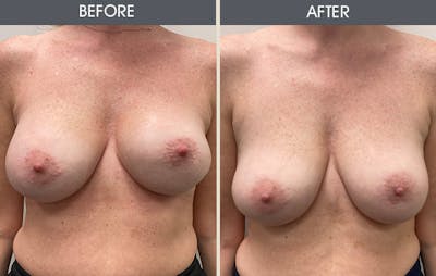 Breast Revision Before & After Gallery - Patient 149430786 - Image 1
