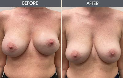 Breast Revision Gallery Before & After Gallery - Patient 149430786 - Image 1