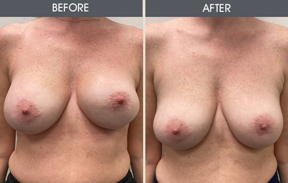 Breast Revision Before & After Gallery - Patient 149430786 - Image 1