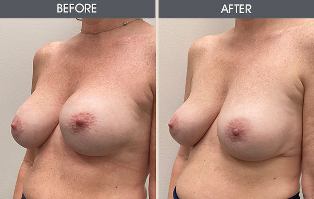 Breast Revision Gallery Before & After Gallery - Patient 149430786 - Image 2