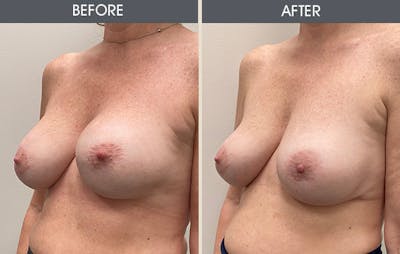 Breast Revision Gallery Before & After Gallery - Patient 149430786 - Image 2