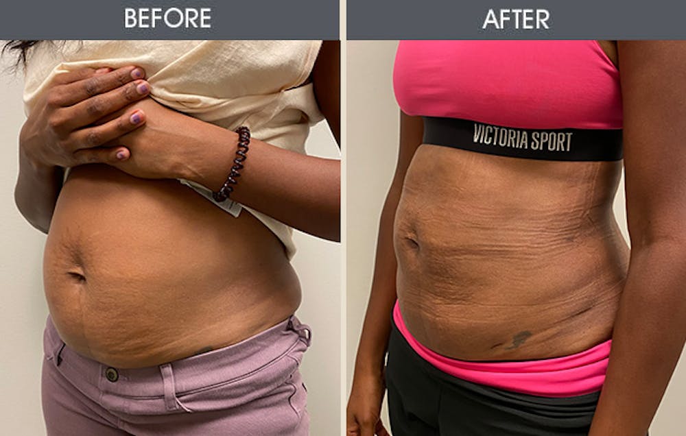 Liposuction Before & After Gallery - Patient 152131448 - Image 1