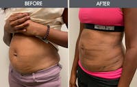 Liposuction Before & After Gallery - Patient 152131448 - Image 1