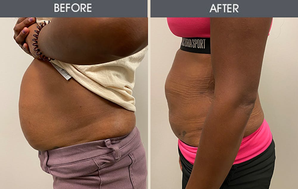 Liposuction Gallery Before & After Gallery - Patient 152131448 - Image 2