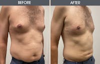 Male Breast Reduction (Gynecomastia) Gallery Before & After Gallery - Patient 179746785 - Image 1