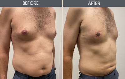 Male Breast Reduction (Gynecomastia)  Before & After Gallery - Patient 179746785 - Image 1