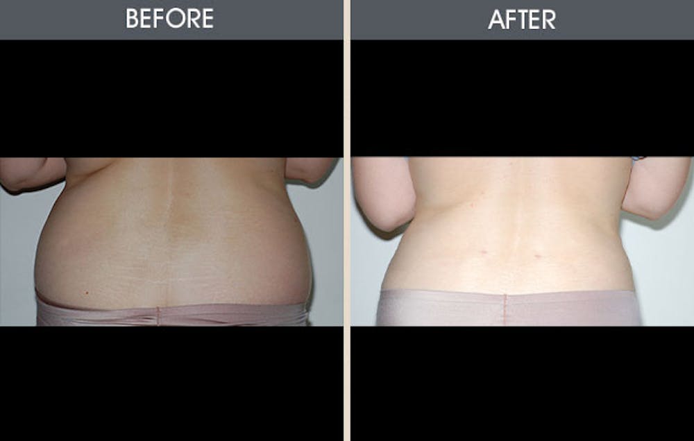 Liposuction Gallery Before & After Gallery - Patient 157358692 - Image 1