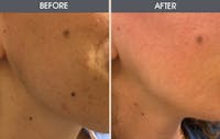 Mole Removal Before & After Gallery - Patient 172097236 - Image 1