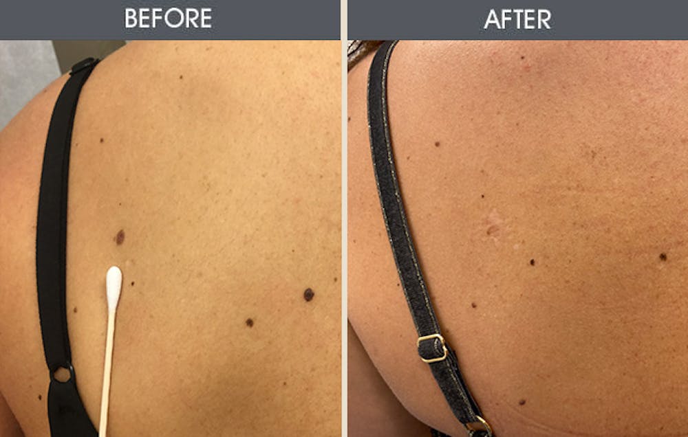 Mole Removal Gallery Before & After Gallery - Patient 172097235 - Image 1