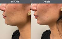 Dermal Fillers Before & After Gallery - Patient 174197035 - Image 1