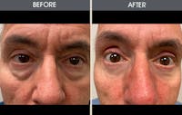 Eyelid Surgery (Blepharoplasty) Gallery Before & After Gallery - Patient 179338962 - Image 1