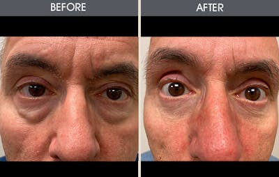 Eyelid Surgery (Blepharoplasty) Gallery Before & After Gallery - Patient 179338962 - Image 1