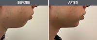 Dermal Fillers Before & After Gallery - Patient 187058637 - Image 1