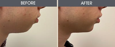 Dermal Fillers Gallery Before & After Gallery - Patient 187058637 - Image 1