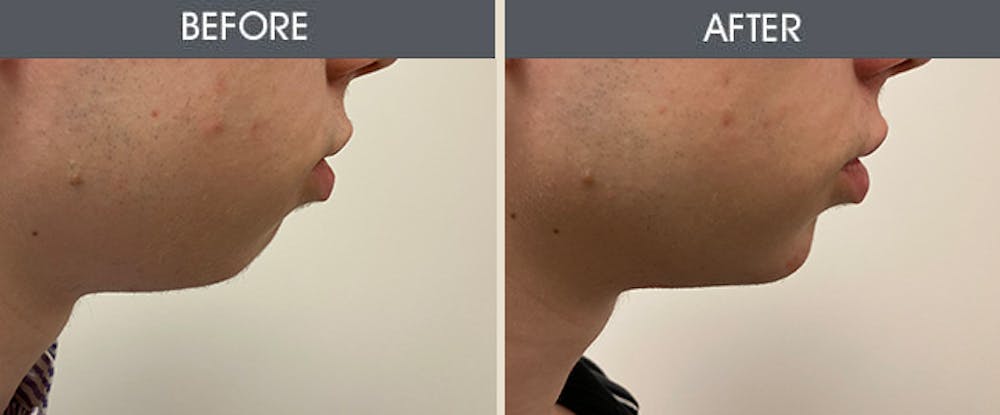 Dermal Fillers Before & After Gallery - Patient 187058637 - Image 1