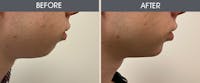 Dermal Fillers Gallery Before & After Gallery - Patient 187058637 - Image 1